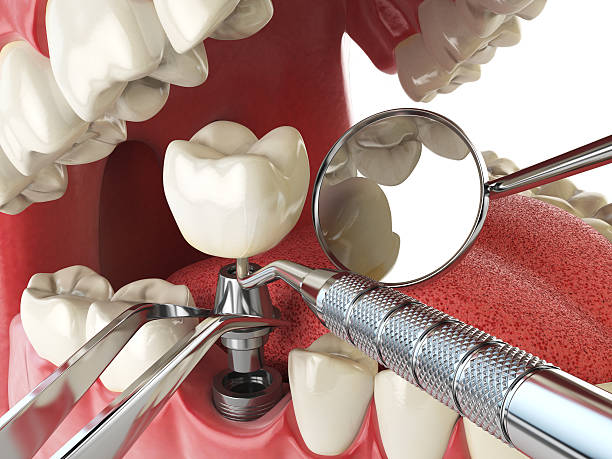 Best Urgent Tooth Repair  in Stevensville, MT